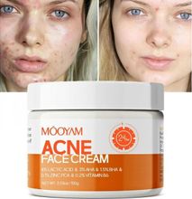 Mooyam Acne Face Cream