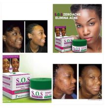 Pharmaderm SOS Zero Acne Face Cream-Treats Acne,Pimples&Darkspots