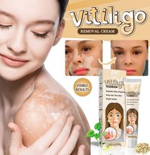 Vitiligo Removal Cleansing Cream Facial Care Ointment Skin Care