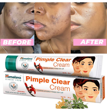 Himalaya Pimple Clear Cream Treats Pimples & Acne